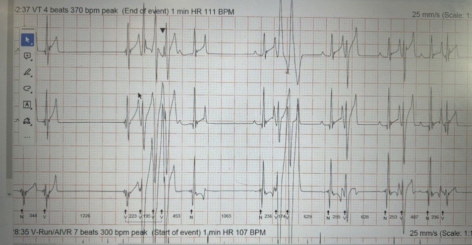 Finn ECG